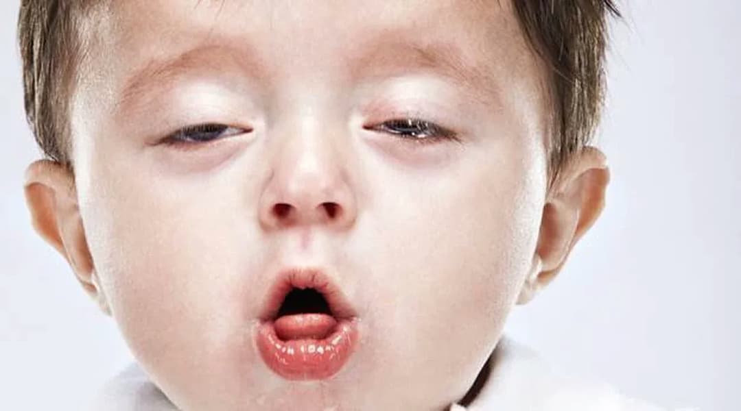 Bệnh ho gà: Dấu hiệu, nguyên nhân, cách xử trí và phòng ngừa