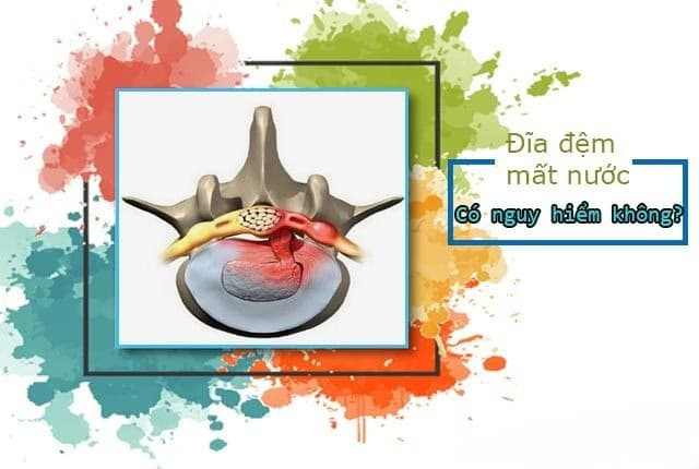 Đĩa đệm mất nước: Nguyên nhân, dấu hiệu và phương pháp chẩn đoán