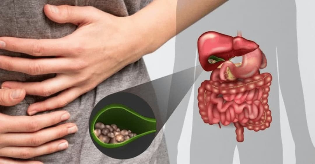 Sỏi bùn túi mật: Nguyên nhân, dấu hiệu và cách điều trị