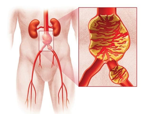 Phình động mạch tạng: Nguyên nhân, triệu chứng và cách điều trị