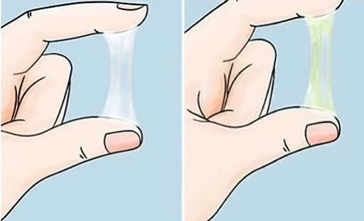 Bệnh huyết trắng: Nguyên nhân, dấu hiệu và cách điều trị