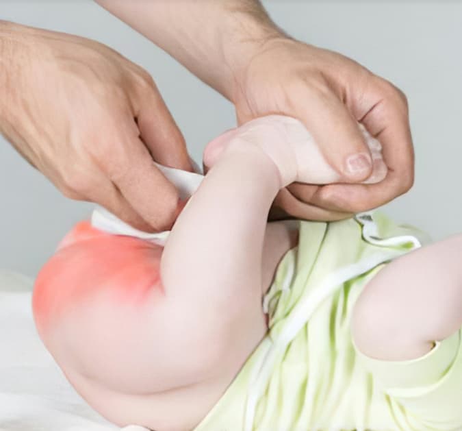 Hăm tã ở trẻ: Nguyên nhân, dấu hiệu và cách chăm sóc