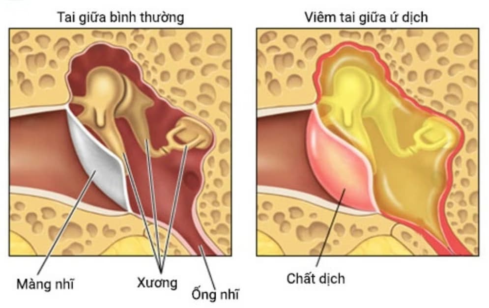 Viêm tai giữa ứ dịch: Nguyên nhân, dấu hiệu và cách điều trị
