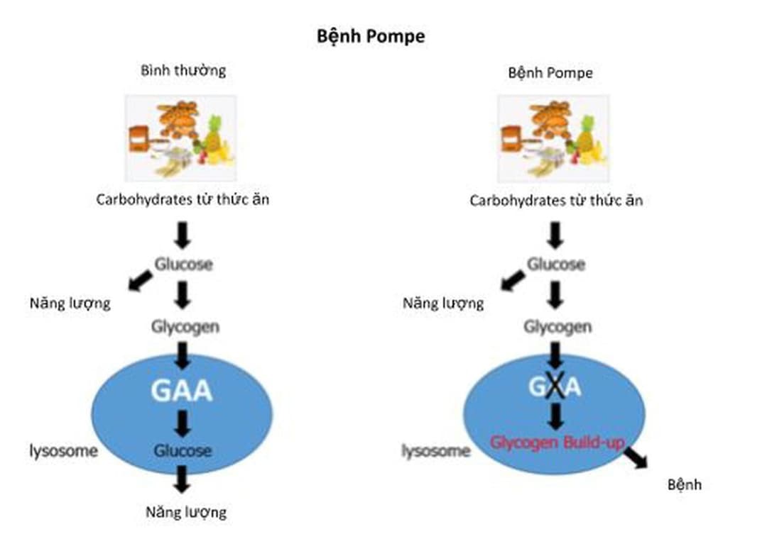 Bệnh Pompe: Nguyên nhân, triệu chứng, chẩn đoán và cách xử trí
