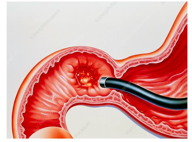 Viêm tá tràng: Nguyên nhân, dấu hiệu và cách điều trị