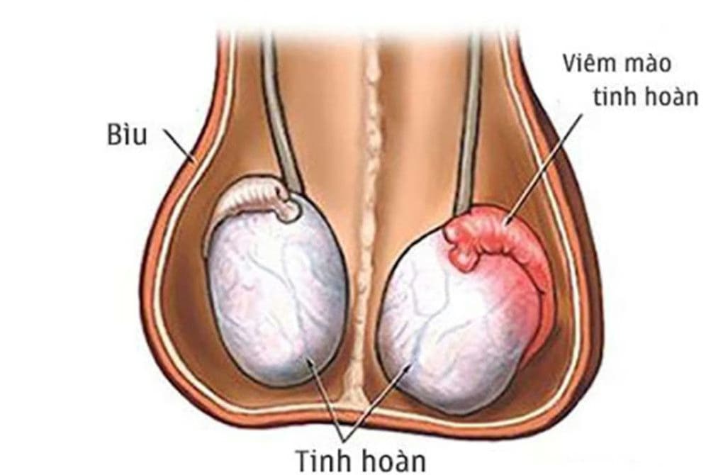 Viêm mào tinh hoàn: Nguyên nhân, triệu chứng và phương pháp xử trí