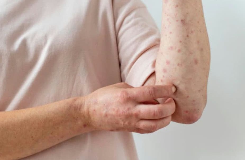 Bệnh giang mai: Dấu hiệu, con đường lây truyền và cách điều trị