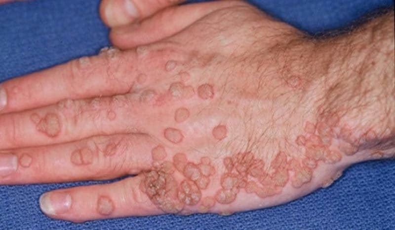 U sùi thể nấm: Nguyên nhân, triệu chứng và cách điều trị