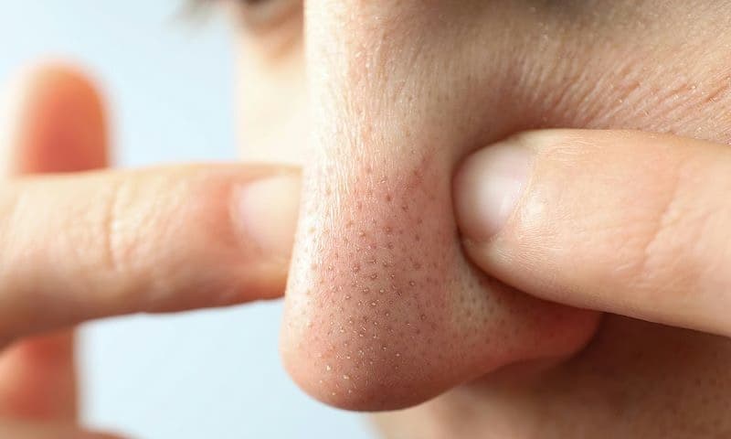 Mụn đầu đen: Bản chất nang lông bít tắc, nguyên nhân và cách chăm sóc chuẩn