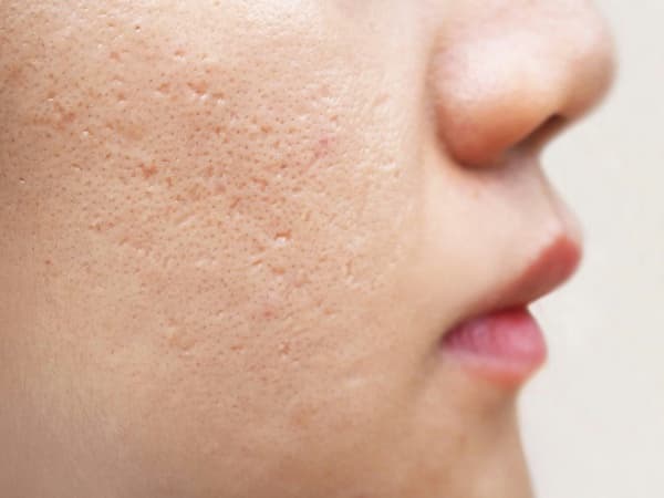 Sẹo rỗ: Nguyên nhân, phân loại dấu hiệu và cách điều trị