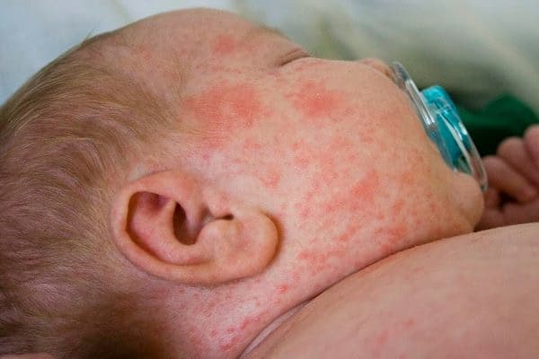 Xuất huyết giảm tiểu cầu: Nguyên nhân, dấu hiệu và cách điều trị
