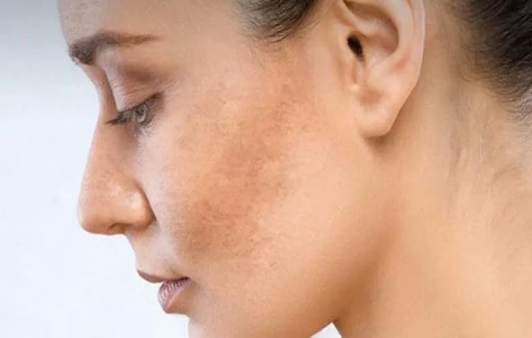 Sạm da là gì? Nguyên nhân, dấu hiệu và cách chăm sóc phục hồi làn da