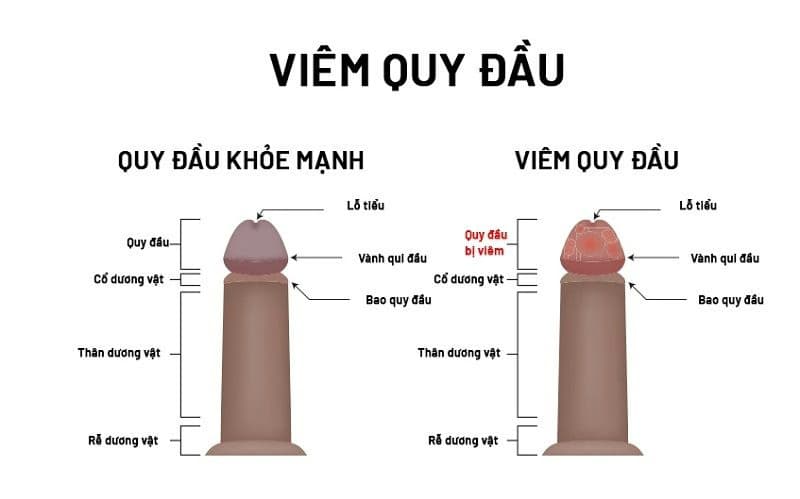 Viêm bao quy đầu: Nguyên nhân, dấu hiệu và cách điều trị