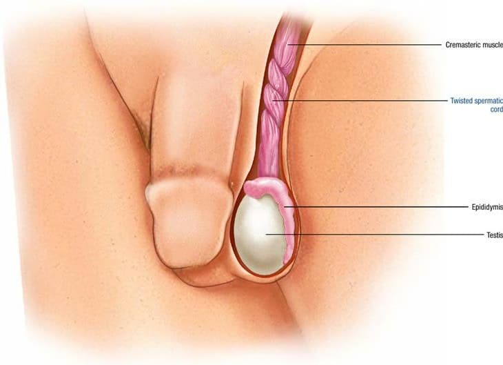 Xoắn tinh hoàn: Dấu hiệu cảnh báo, nguyên nhân và xử trí cấp cứu