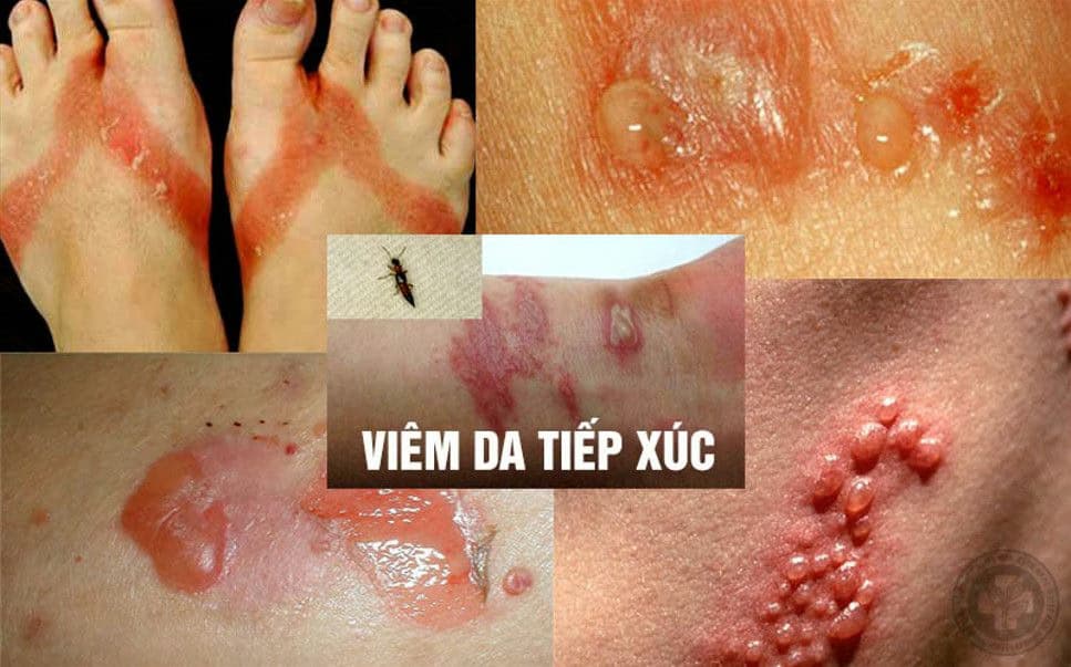Viêm da tiếp xúc: Nguyên nhân, triệu chứng, chẩn đoán và cách chăm sóc