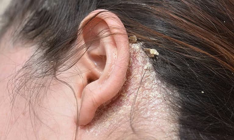 Viêm da tiết bã: Nguyên nhân, dấu hiệu và cách kiểm soát