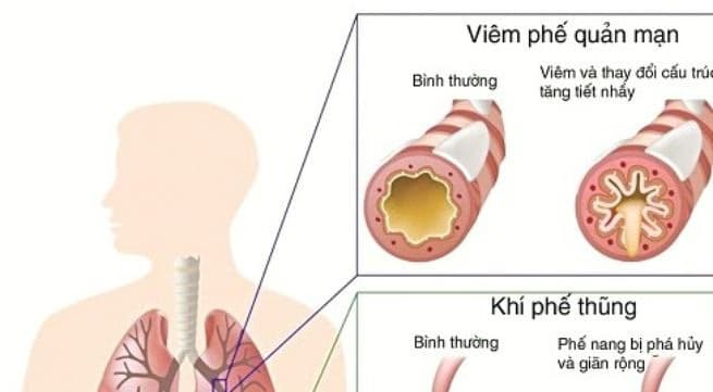 Viêm phế quản mạn tính: Nguyên nhân, triệu chứng và cách kiểm soát bệnh