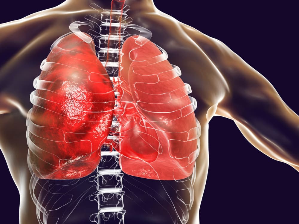 Bệnh viêm phổi: Nguyên nhân, dấu hiệu và cách điều trị
