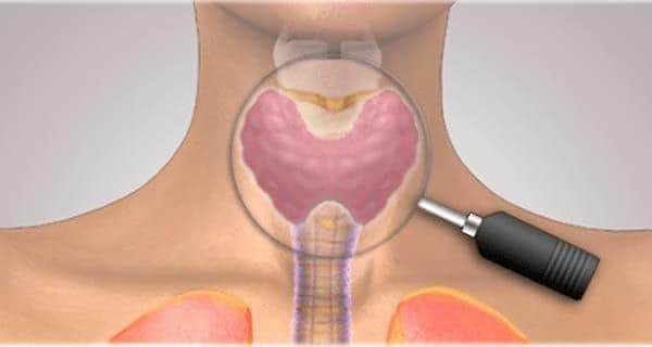 Viêm tuyến giáp Hashimoto: Nguyên nhân, triệu chứng, chẩn đoán và cách kiểm soát