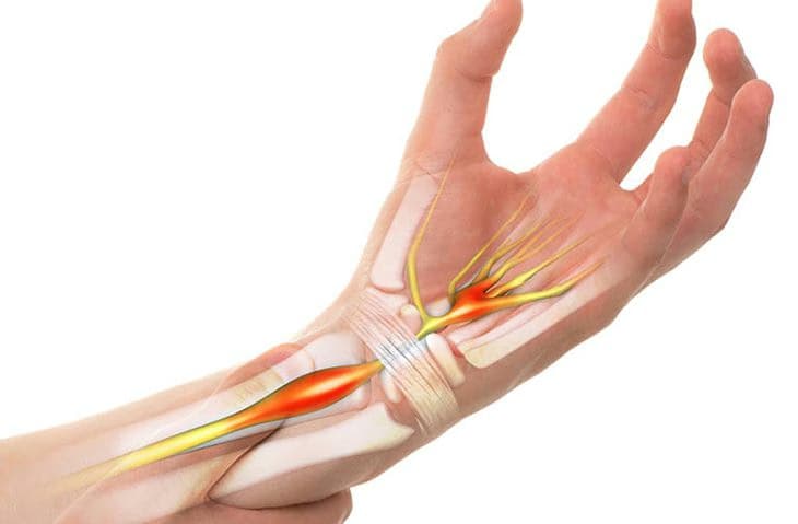 Tê bàn tay: Nguyên nhân, dấu hiệu cảnh báo, chẩn đoán và điều trị