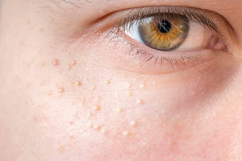 Mụn đầu trắng: Nguyên nhân, triệu chứng và cách chăm sóc