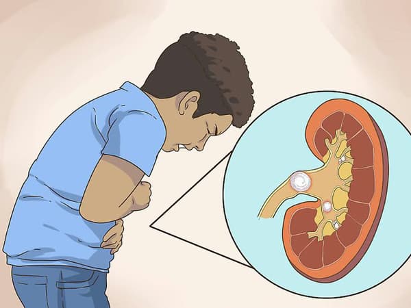 Hội chứng Bartter: Nguyên nhân, dấu hiệu và cách điều trị