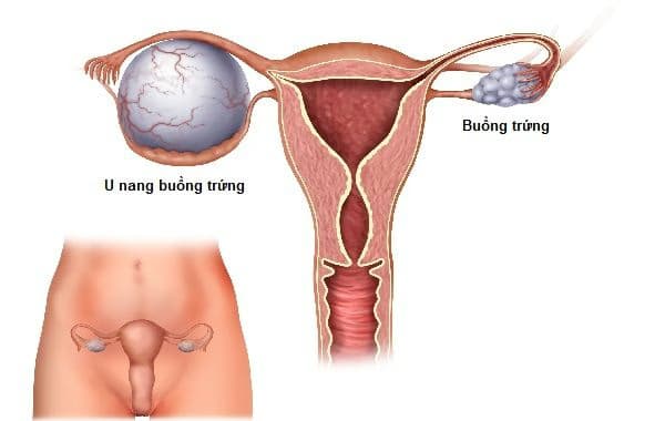 U nang buồng trứng: Nguyên nhân, dấu hiệu và cách điều trị