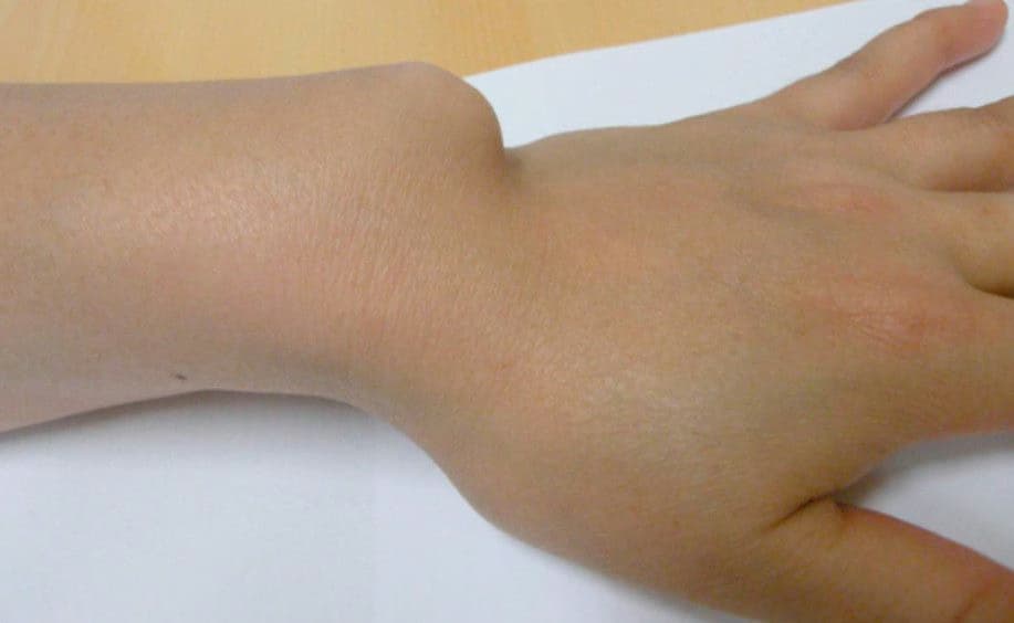 Bệnh Madelung: Nguyên nhân, triệu chứng và cách điều trị
