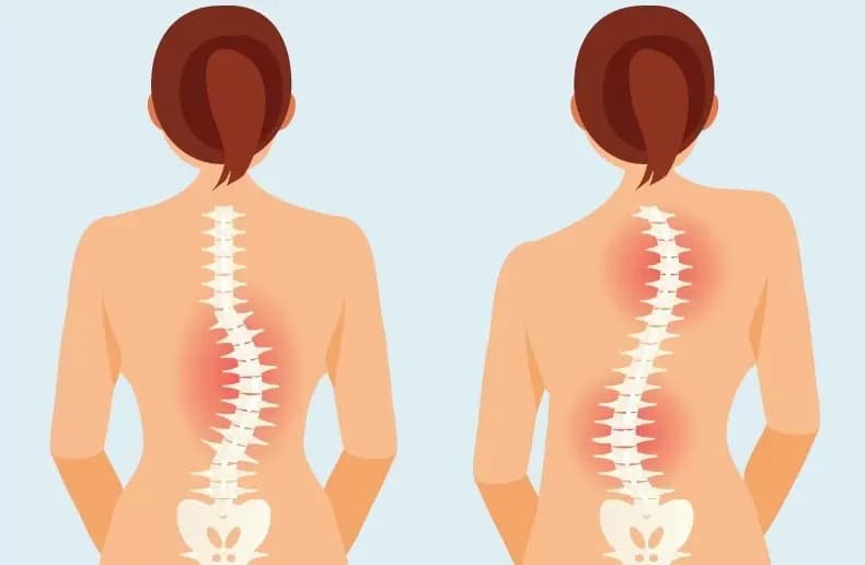 Cong vẹo cột sống: Dấu hiệu, nguyên nhân và các phương pháp chẩn đoán