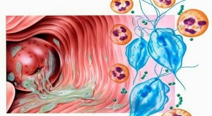 Viêm âm đạo do trùng roi Trichomonas: Nguyên nhân, dấu hiệu và cách điều trị