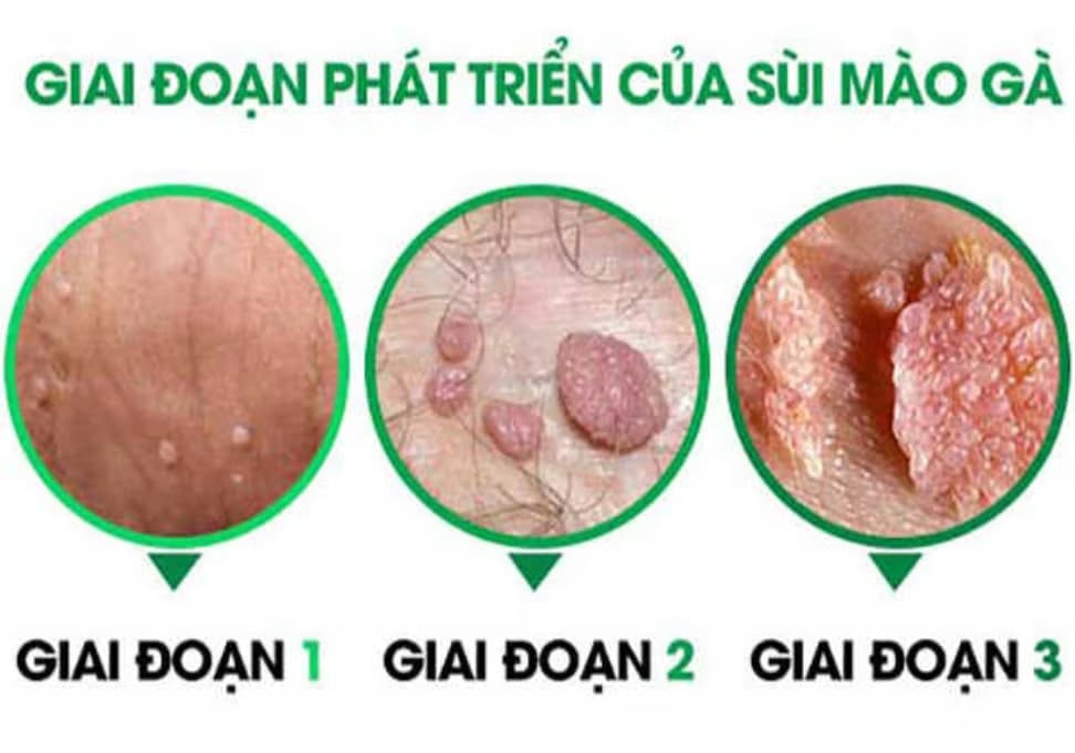 Bệnh sùi mào gà: Nguyên nhân, triệu chứng, chẩn đoán và cách điều trị