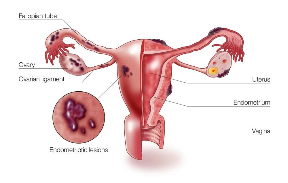 Lạc nội mạc trong cơ tử cung: Nguyên nhân, dấu hiệu và cách điều trị