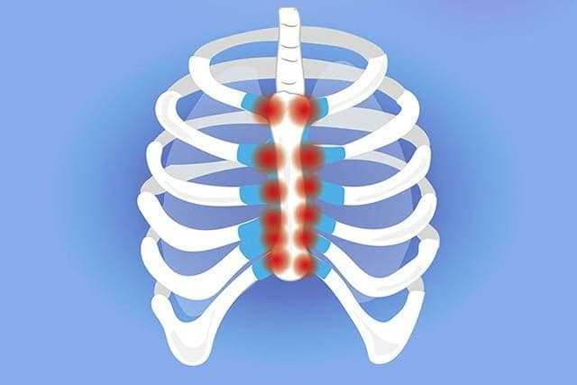 Viêm sụn sườn: Nguyên nhân, dấu hiệu, chẩn đoán và cách xử trí