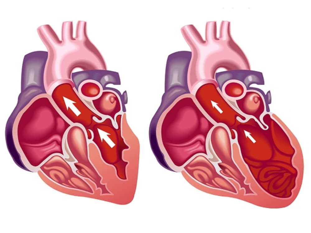 Bệnh suy tim: Dấu hiệu sớm, nguyên nhân và cách điều trị