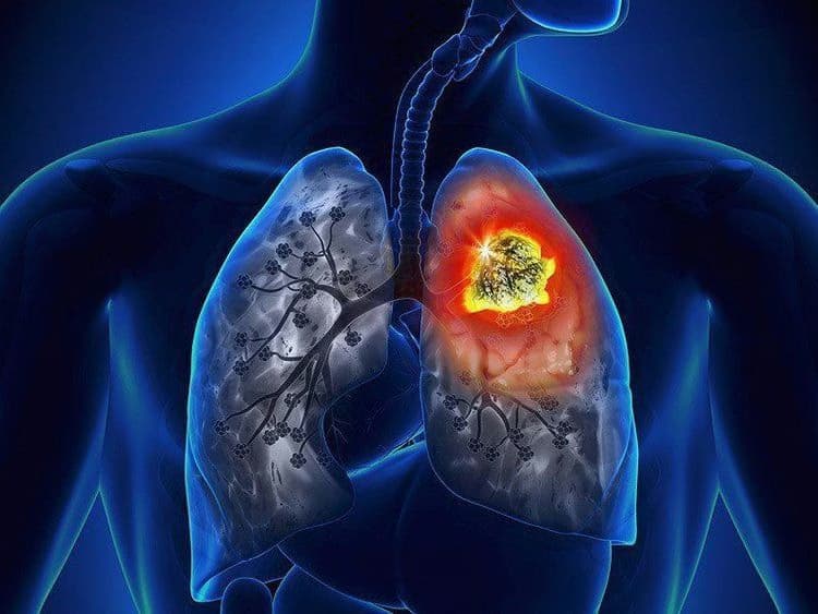 Xuất huyết phế nang lan tỏa: Nguyên nhân, dấu hiệu và cách điều trị