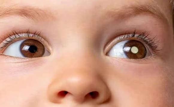U nguyên bào võng mạc ở trẻ em: Nguyên nhân, dấu hiệu và cách điều trị