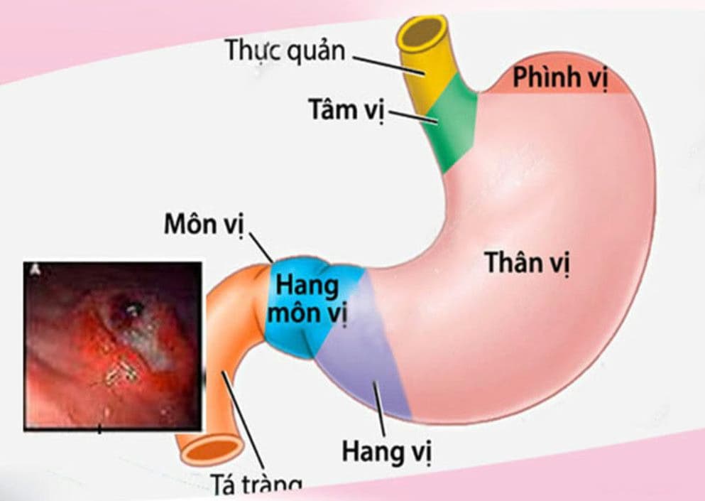 Viêm xung huyết hang vị dạ dày: Nguyên nhân, dấu hiệu và cách điều trị