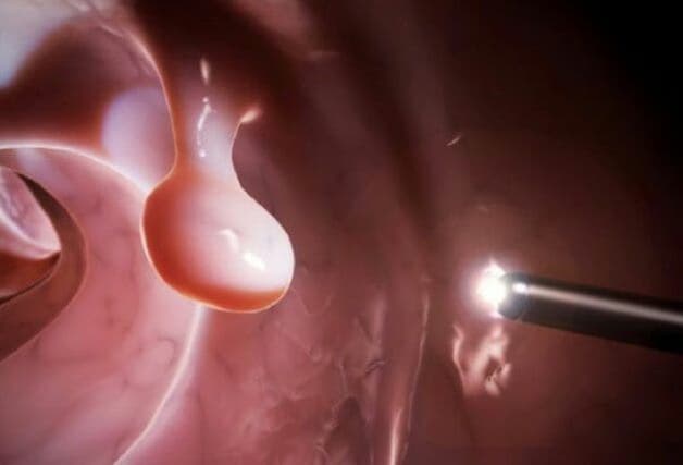 Polyp dạ dày: Nguyên nhân, triệu chứng, mức độ nguy hiểm và cách xử trí