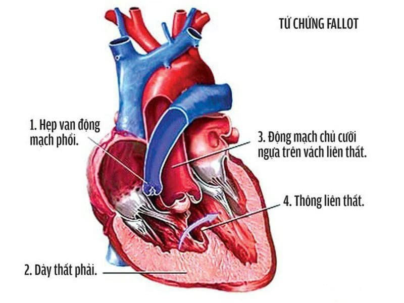 Bệnh tim bẩm sinh: Nguyên nhân, dấu hiệu và cách điều trị