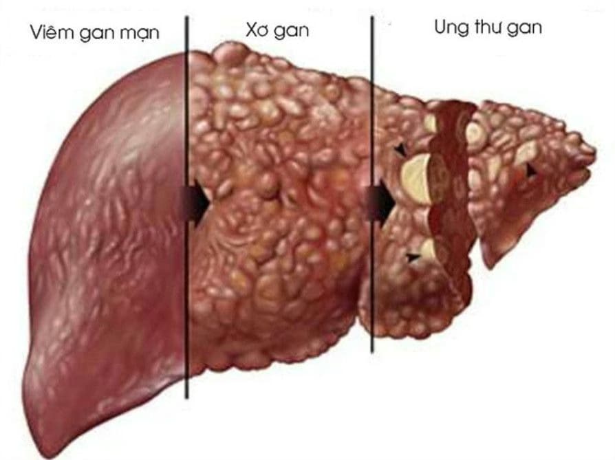 Bệnh viêm gan: Nguyên nhân, dấu hiệu, chẩn đoán và cách điều trị