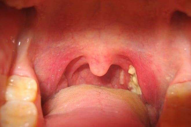 Viêm họng cấp