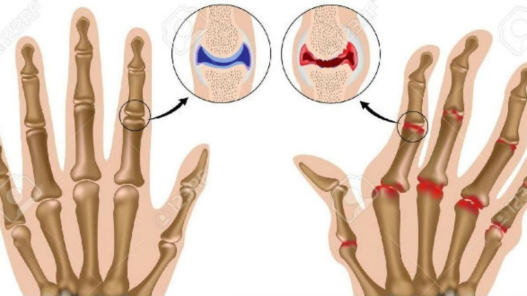 Thoái hóa khớp cổ tay: Nguyên nhân, dấu hiệu và cách kiểm soát