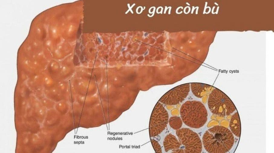 Xơ gan còn bù: Dấu hiệu, nguyên nhân và cách kiểm soát
