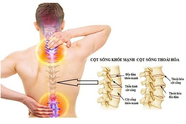 Thoái hóa cột sống: Nguyên nhân, triệu chứng và các phương pháp kiểm soát bệnh