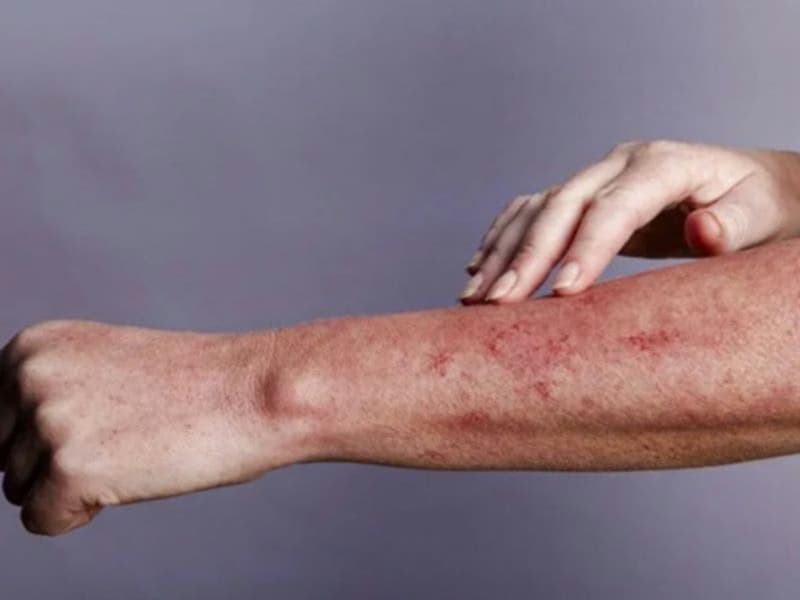 Hội chứng Stevens – Johnson: Nguyên nhân, dấu hiệu và cách xử trí