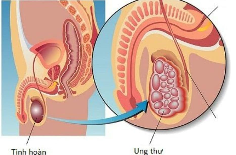 Ung thư tinh hoàn: Nguyên nhân, dấu hiệu và cách điều trị
