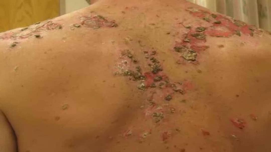 Bệnh da bọng nước tự miễn Pemphigus: Nguyên nhân, triệu chứng và cách điều trị