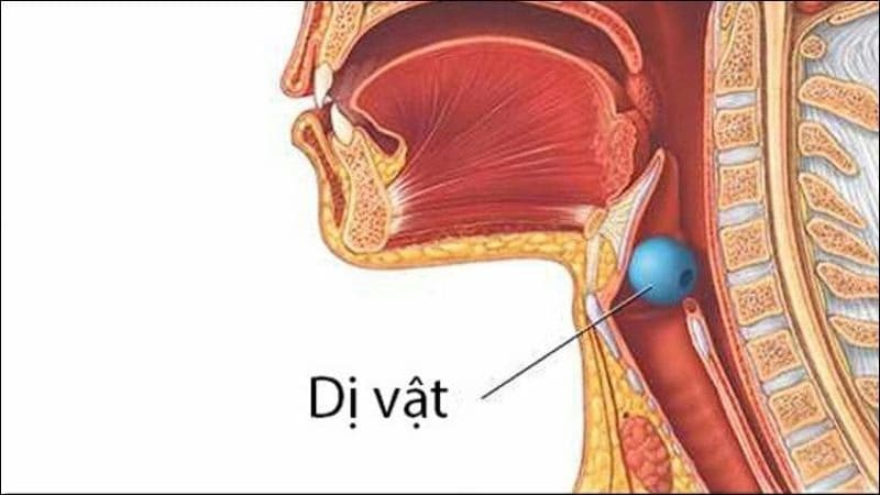 Dị vật đường thở: Nguyên nhân, dấu hiệu, xử trí và phòng ngừa