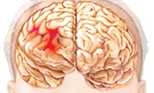 Nhũn não: Nguyên nhân, dấu hiệu, chẩn đoán và cách điều trị