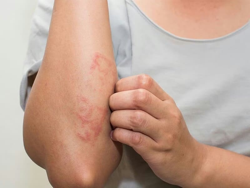 Bệnh viêm da: Phân loại, nguyên nhân, triệu chứng và cách điều trị